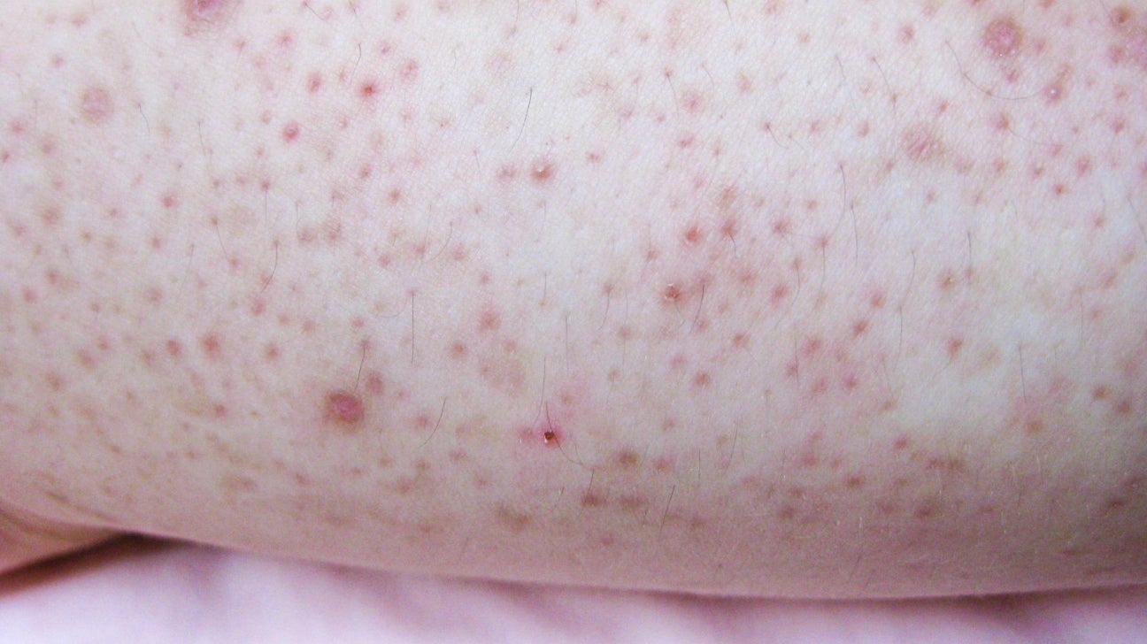 Bump Chicken Skin Back To The Coop How To Treat Keratosis Pilaris 