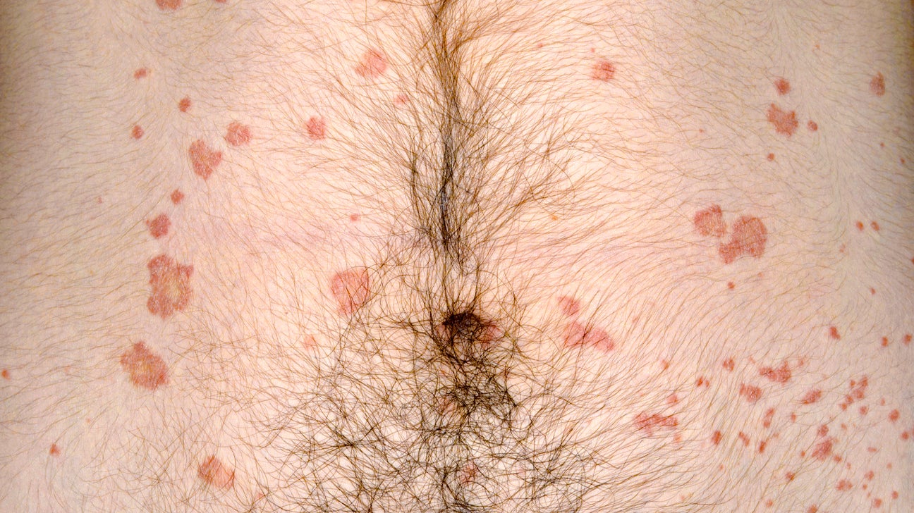psoriasis mi a kezels vörös foltok a hónalj közelében és viszketés