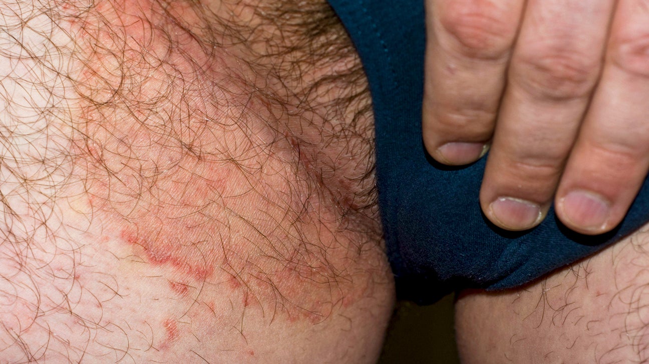раздражение кожи у мужчин на груди фото 117