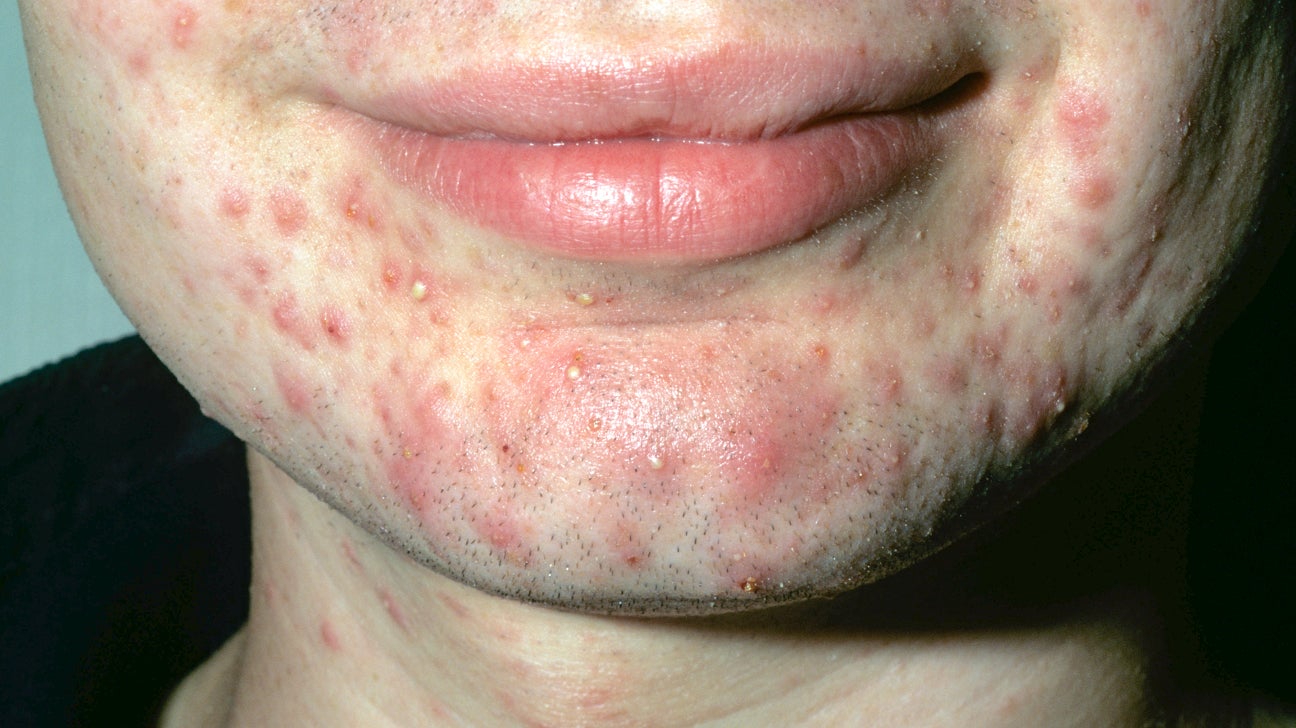 pustules