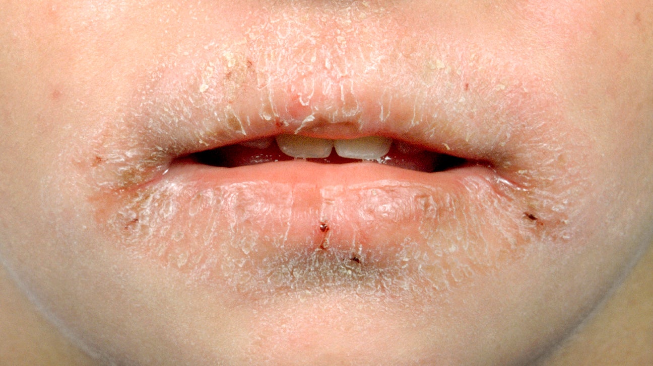 psoriasis-on-lips-and-nose-lipstutorial