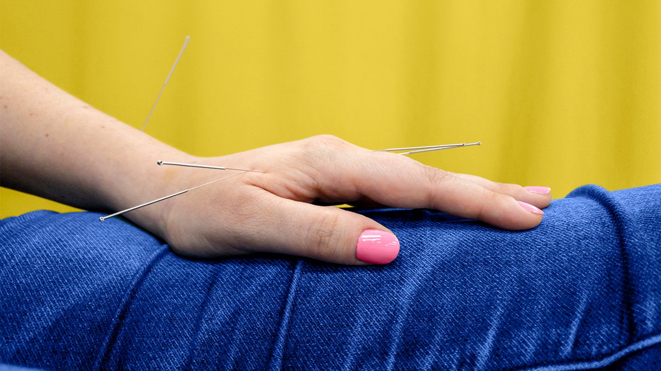 acupuncture for psoriasis