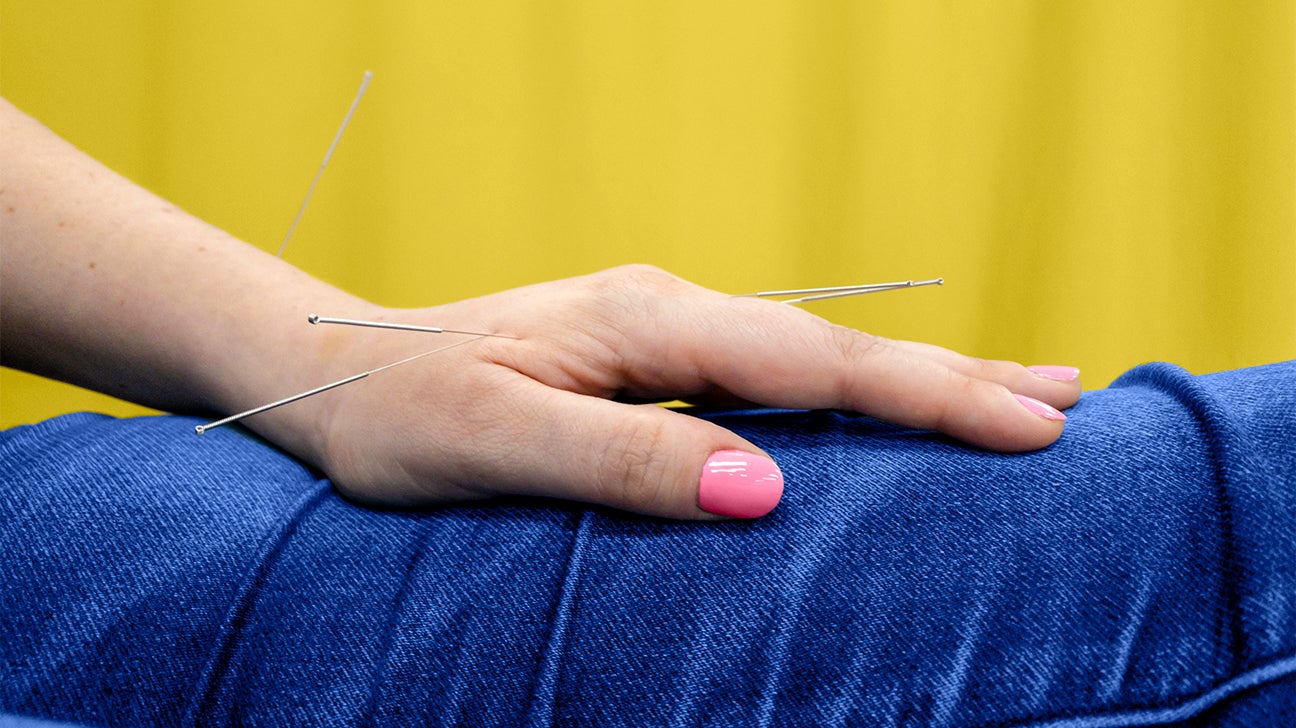 Acupuncture For Psoriasis Does It Help