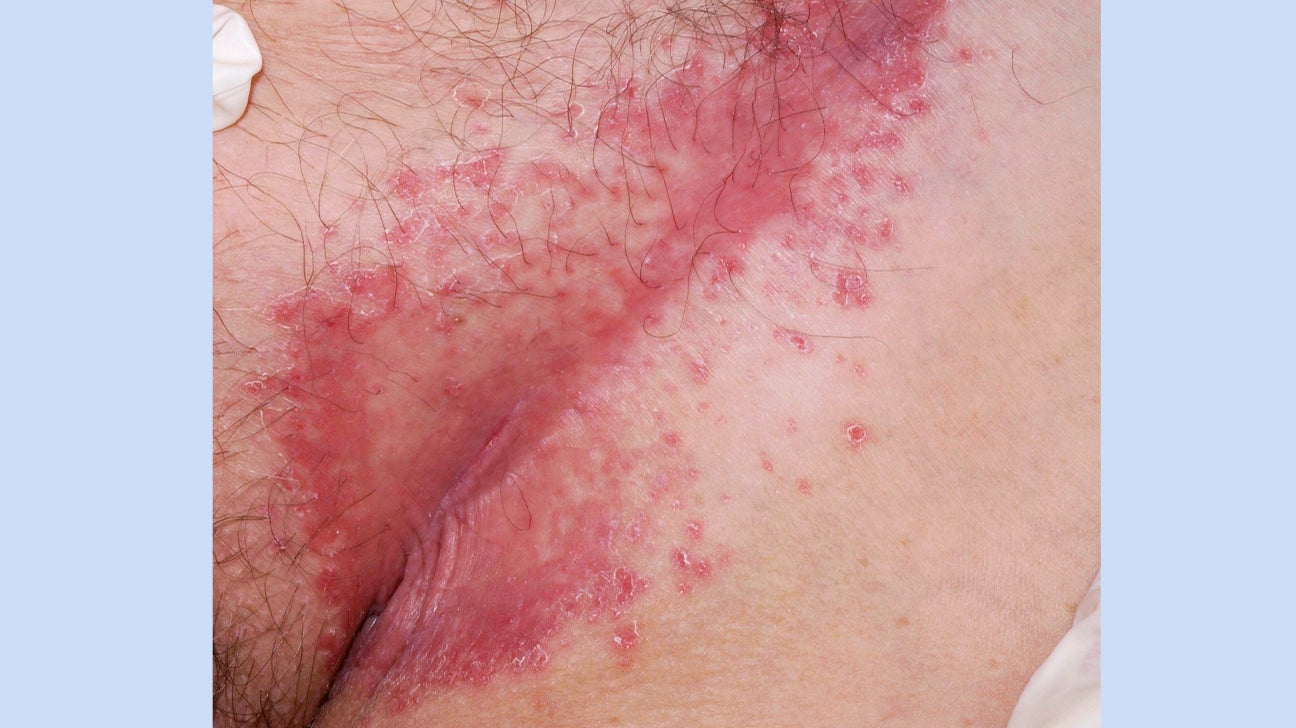 inverse psoriasis genital