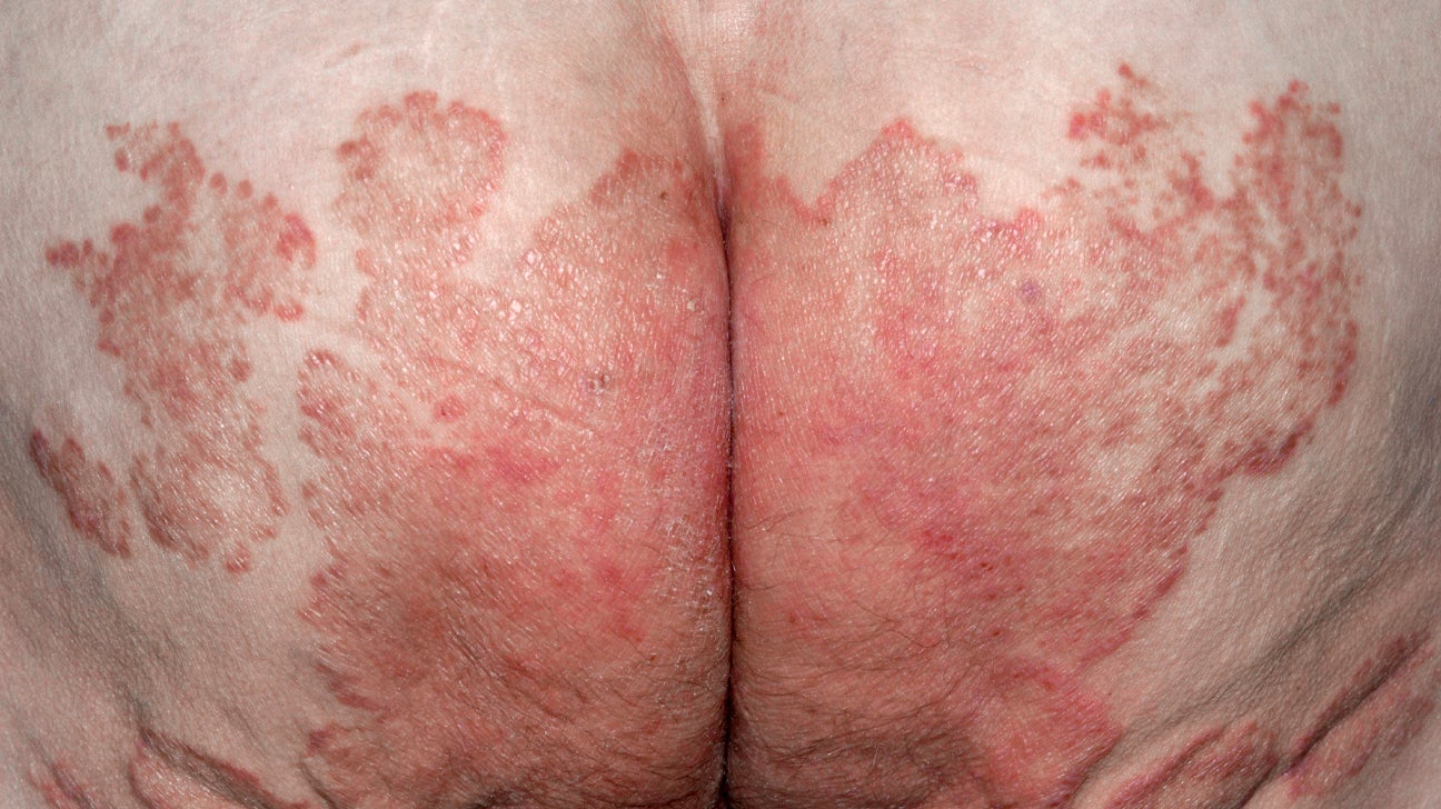 psoriasis symptoms genital area