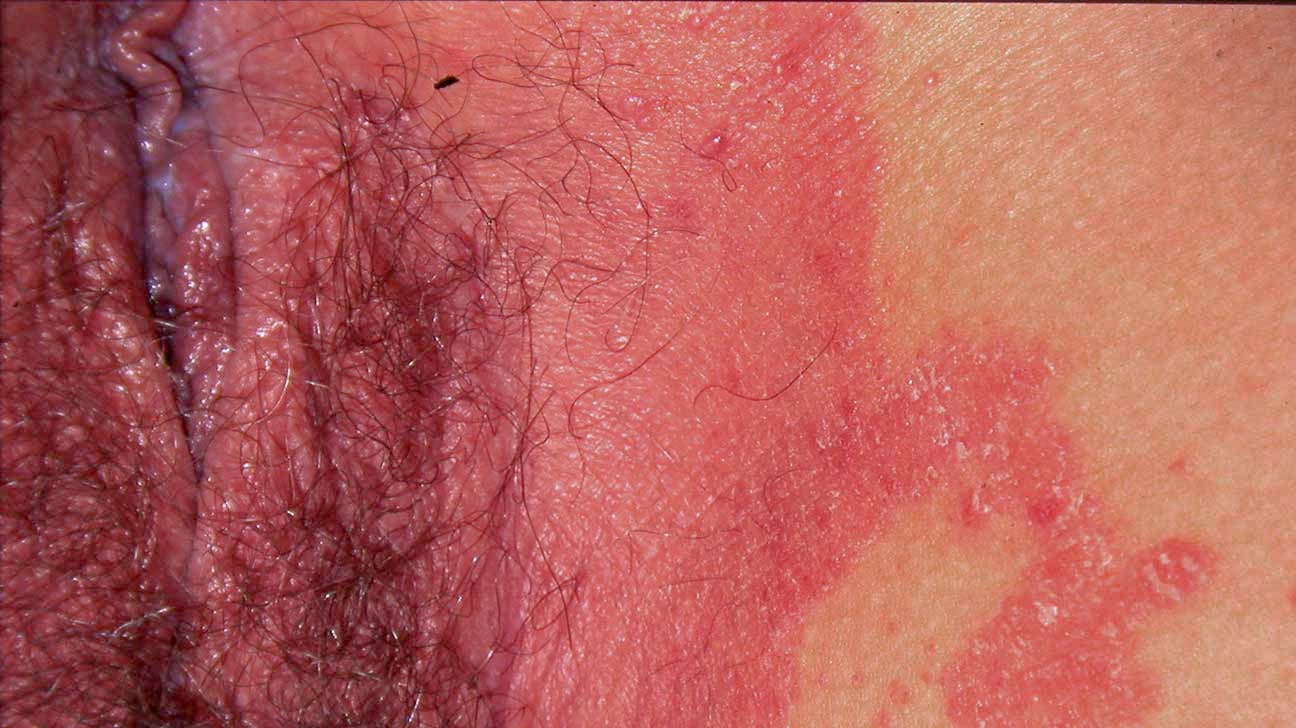 does genital psoriasis burn