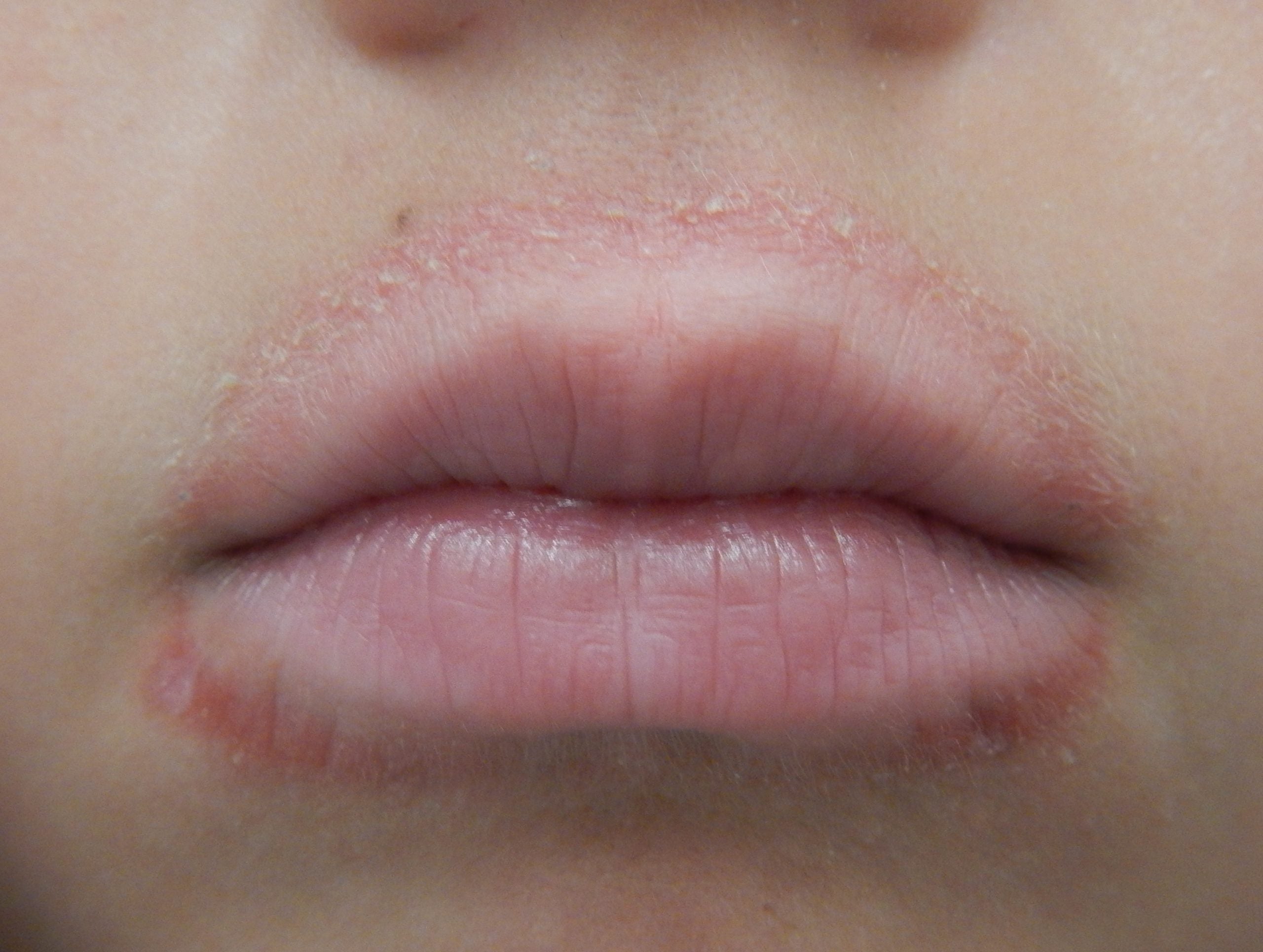 dyshidrotic-eczema-on-the-lips-lipstutorial