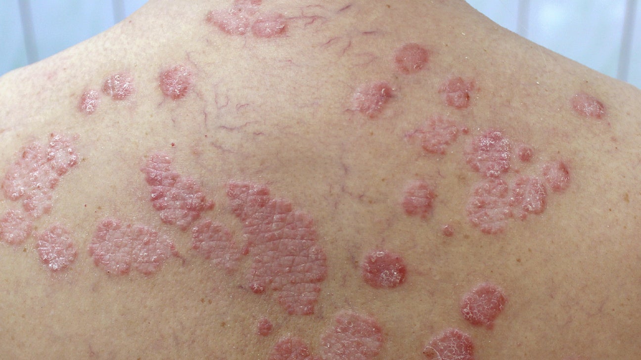 psoriasis hot to touch