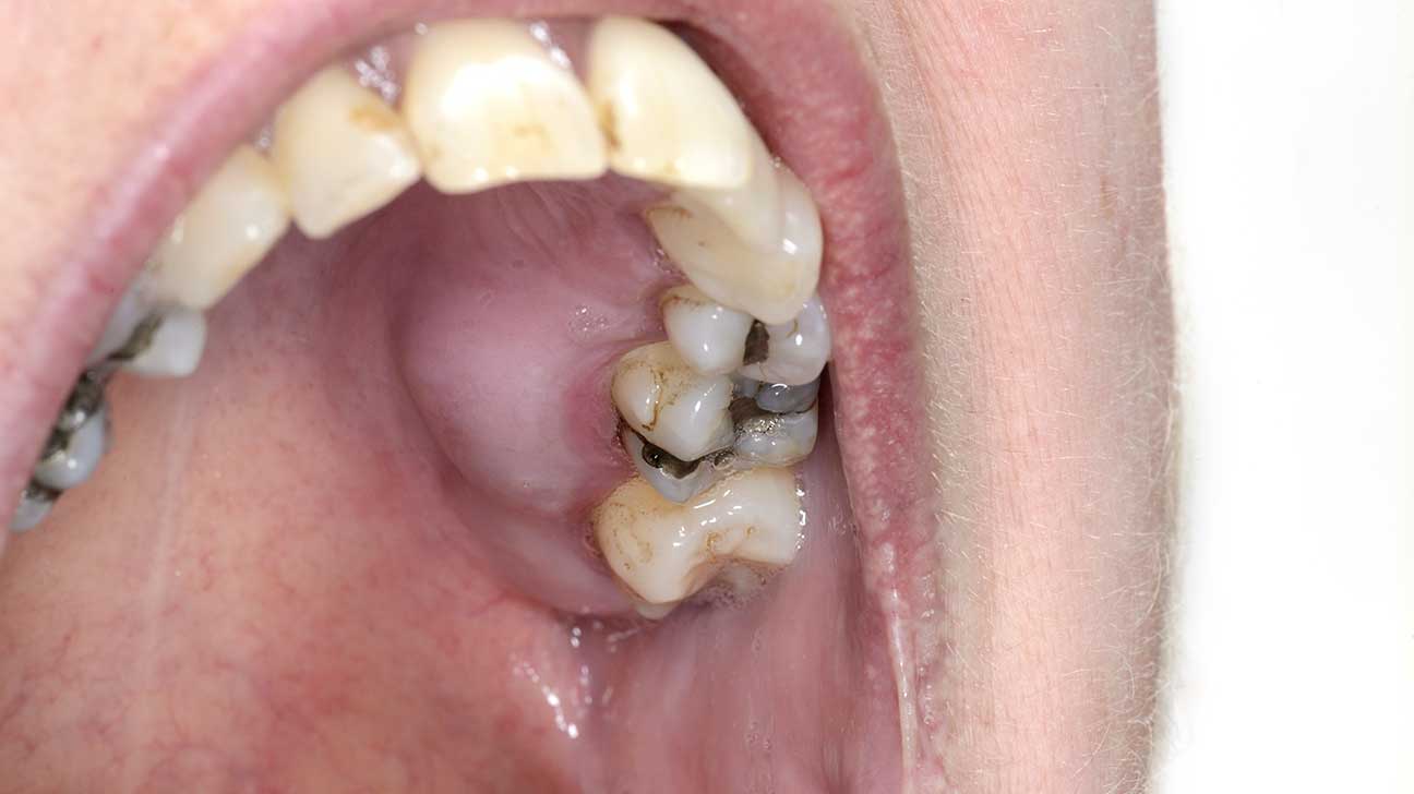 how to drain a tooth abscess