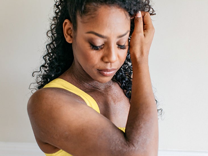 Eczema on Black Skin: Pictures, Symptoms, and Treatment