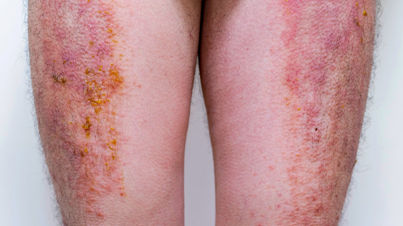 atopic dermatitis pictures on legs)