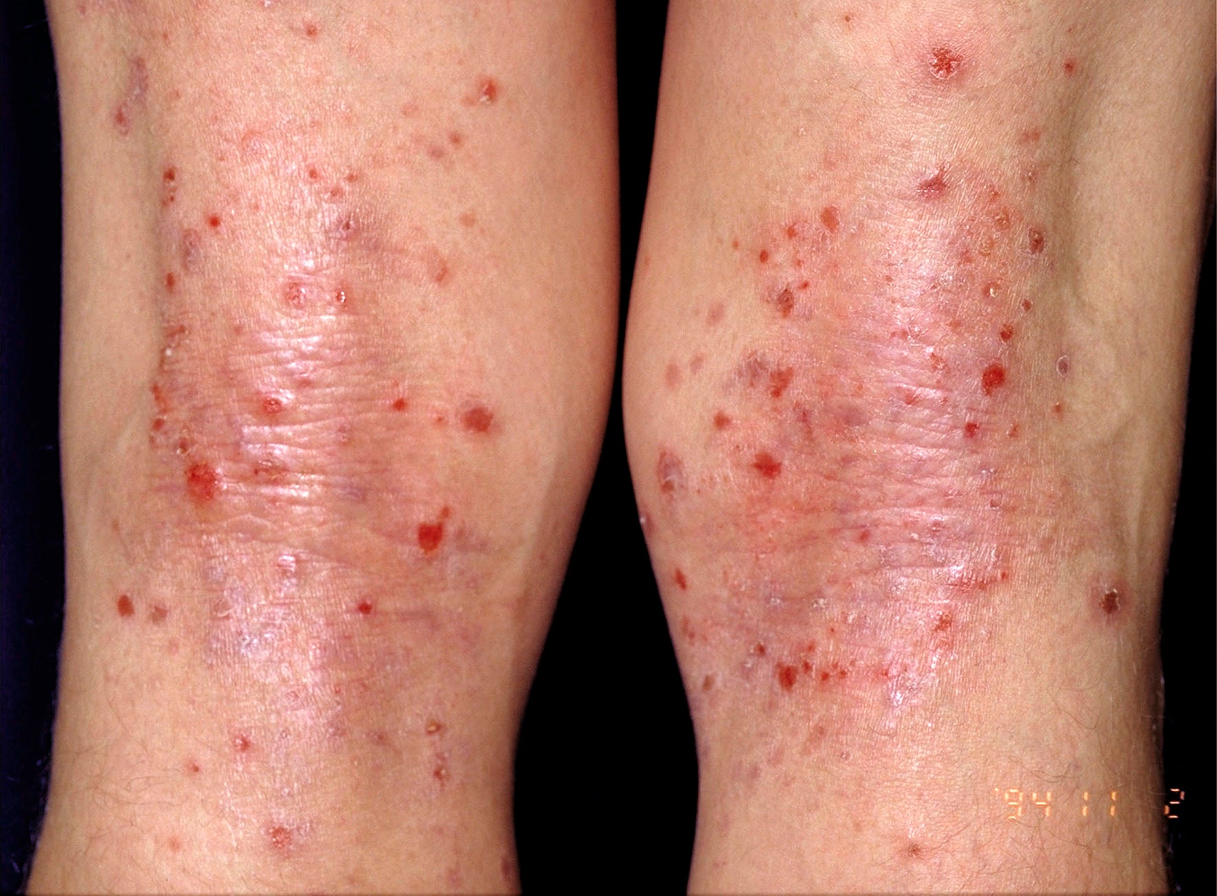 Legzema What Eczema On Your Legs Looks Like And Means Greatist Pro