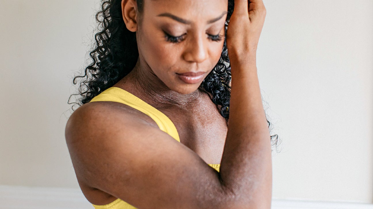 A woman with dark skin wearing a yellow tank top looks down at symptoms of eczema on her arm and chest.