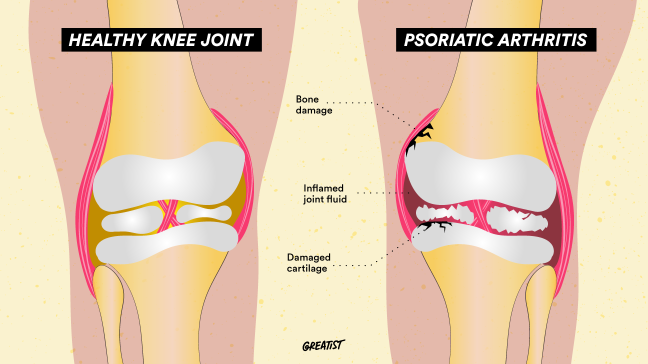 psoriatic arthritis knee