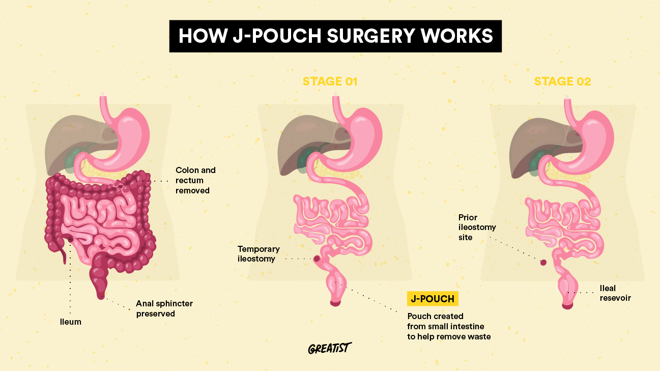What Is J Pouch Surgery Procedure Stages 8479