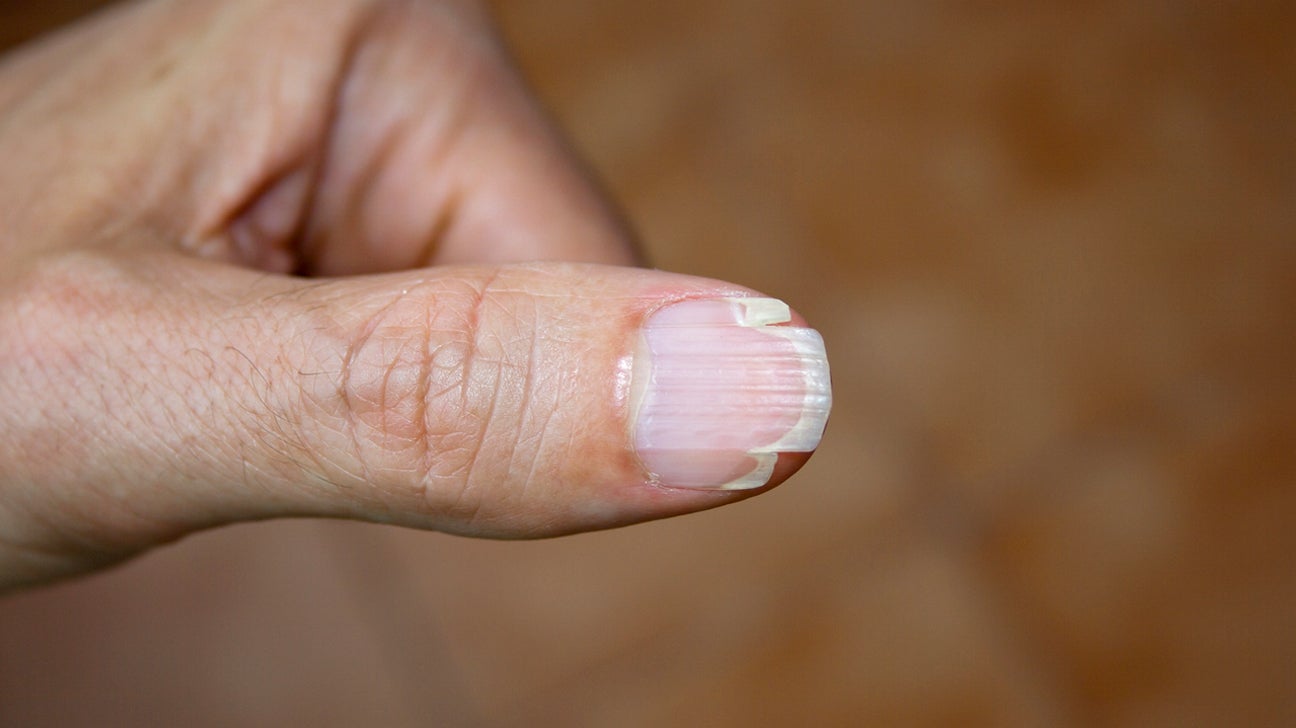 nail és arthritis gomba