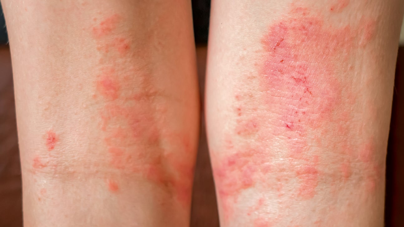 atopic dermatitis, eczema