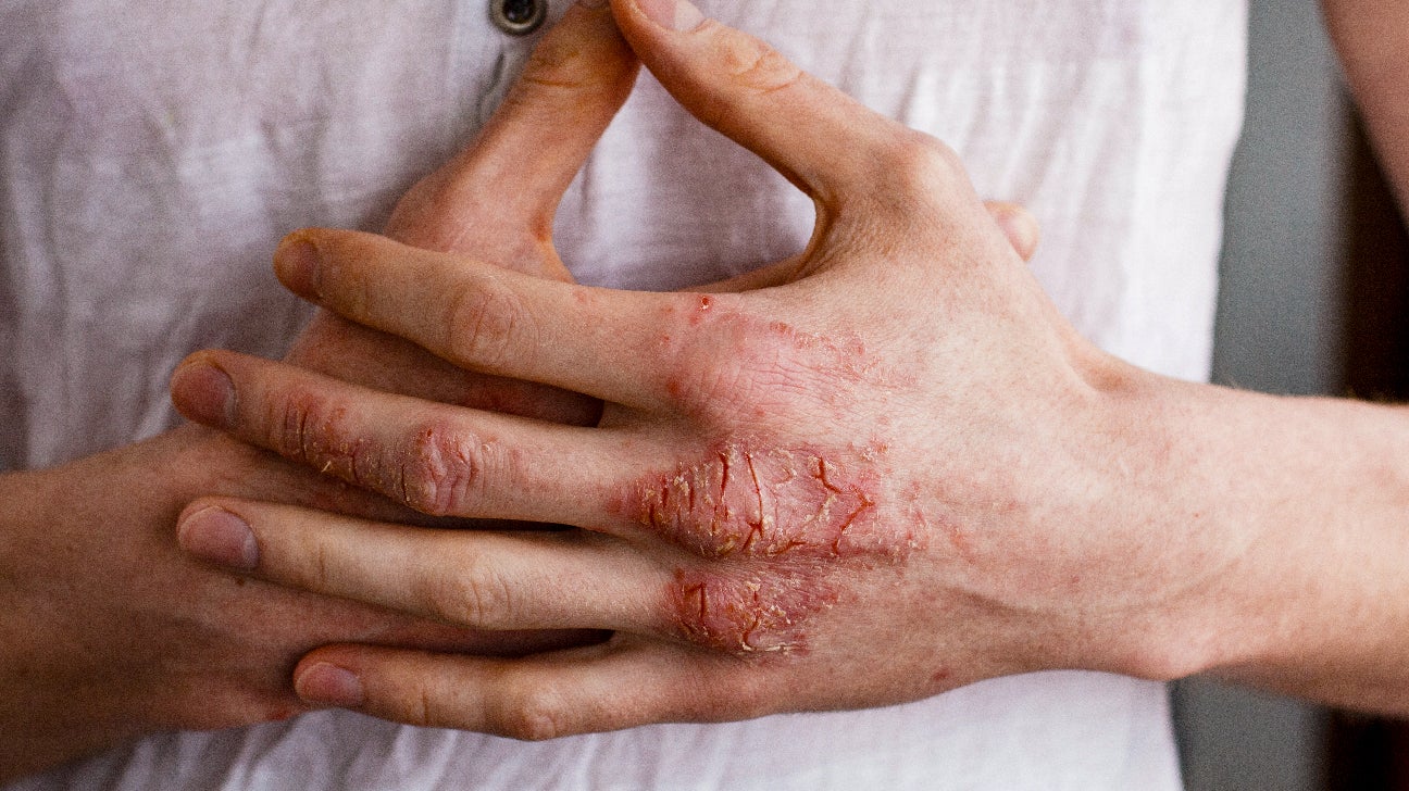 eczema, atopic dermatitis, hands