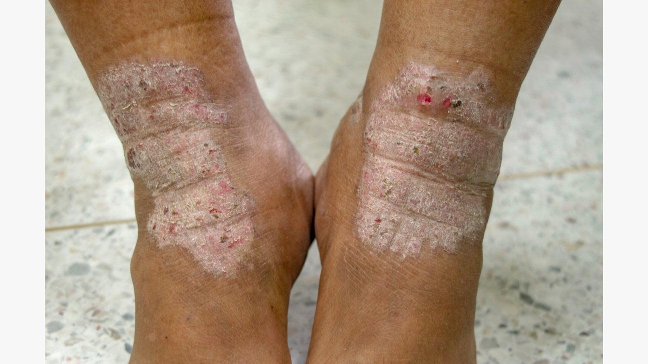 atopic dermatitis, eczema