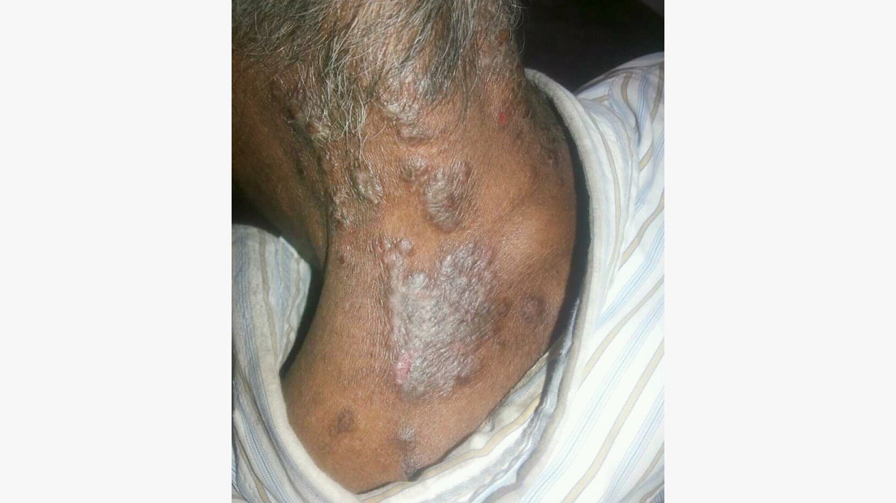 psoriasis