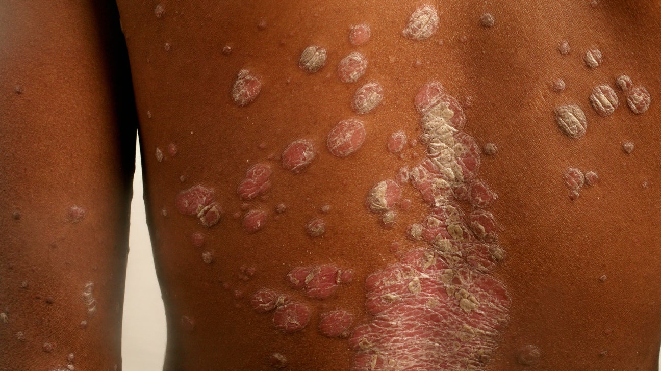 psoriasis