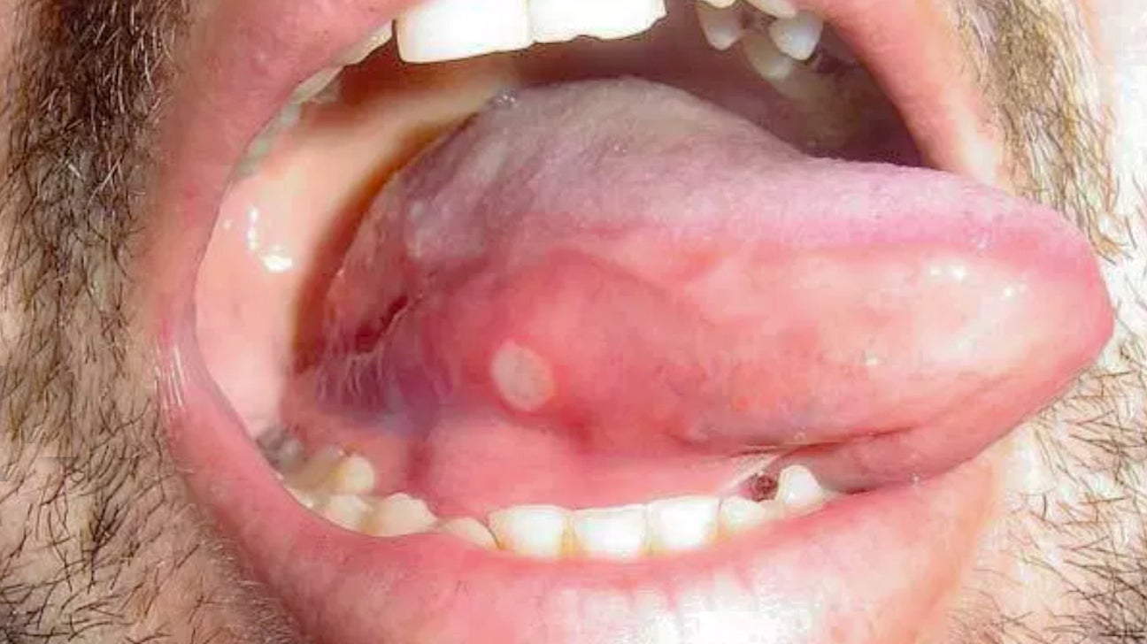 canker sore on tongue