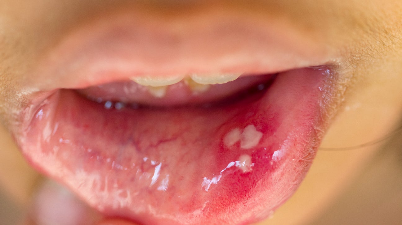cluster of mouth ulcers