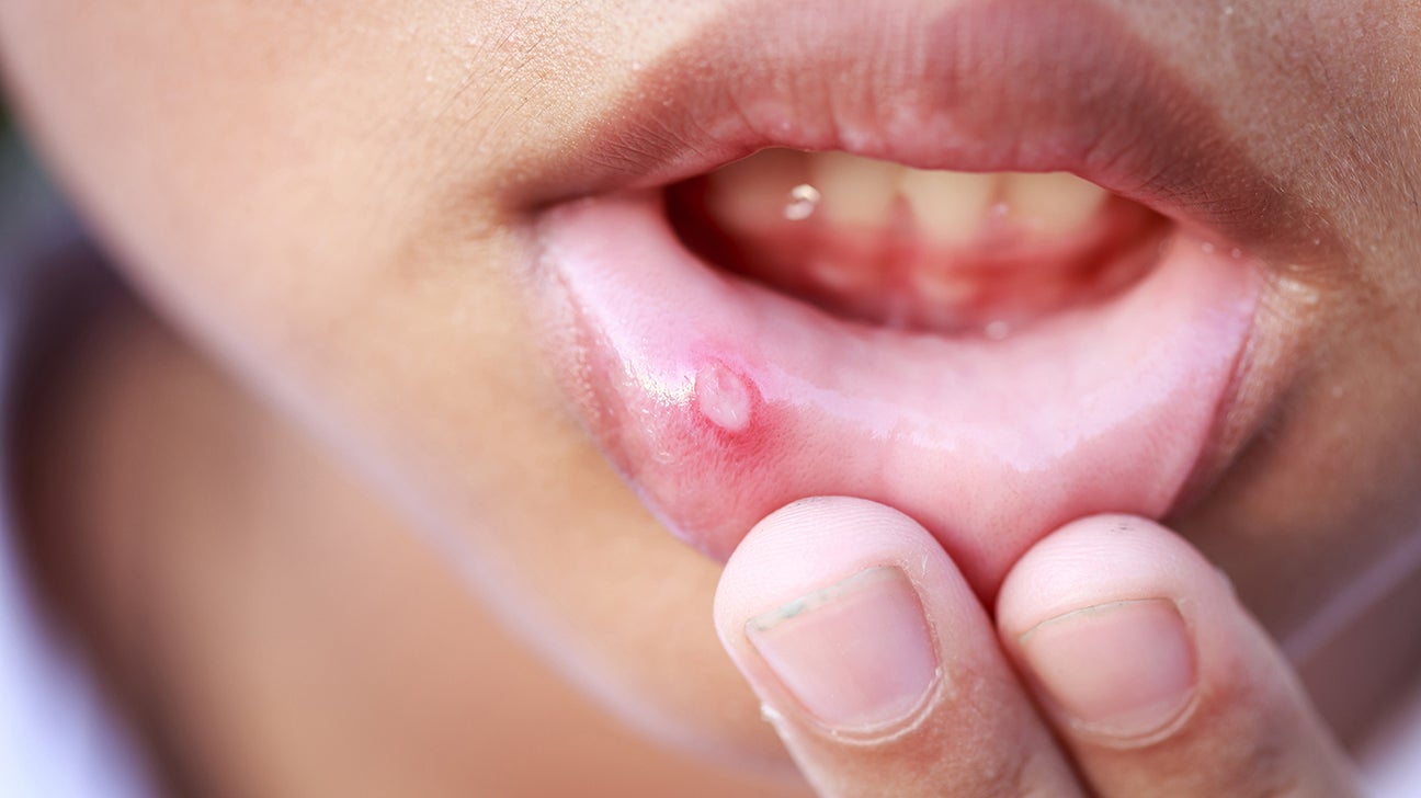 mouth ulcer on lip