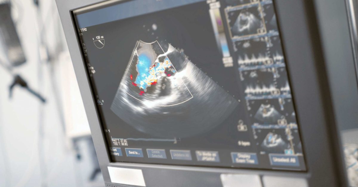 what-is-an-echocardiogram-uses-procedure-and-results