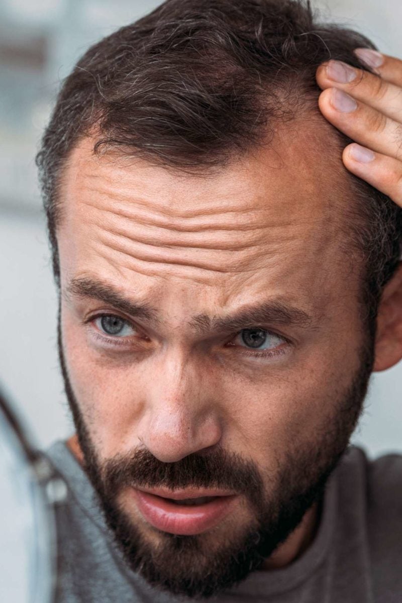 Thyroid And Hair Loss Symptoms Treatment And Outlook