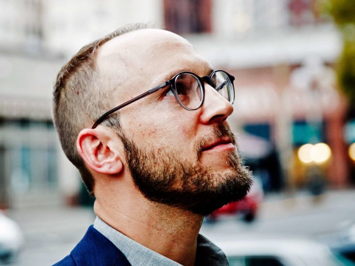 Hair Loss On Temples Causes And What To Do