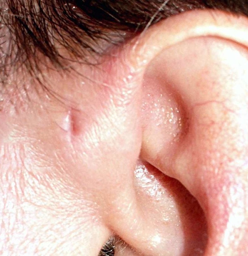 Hole in ear (preauricular pit): What to know