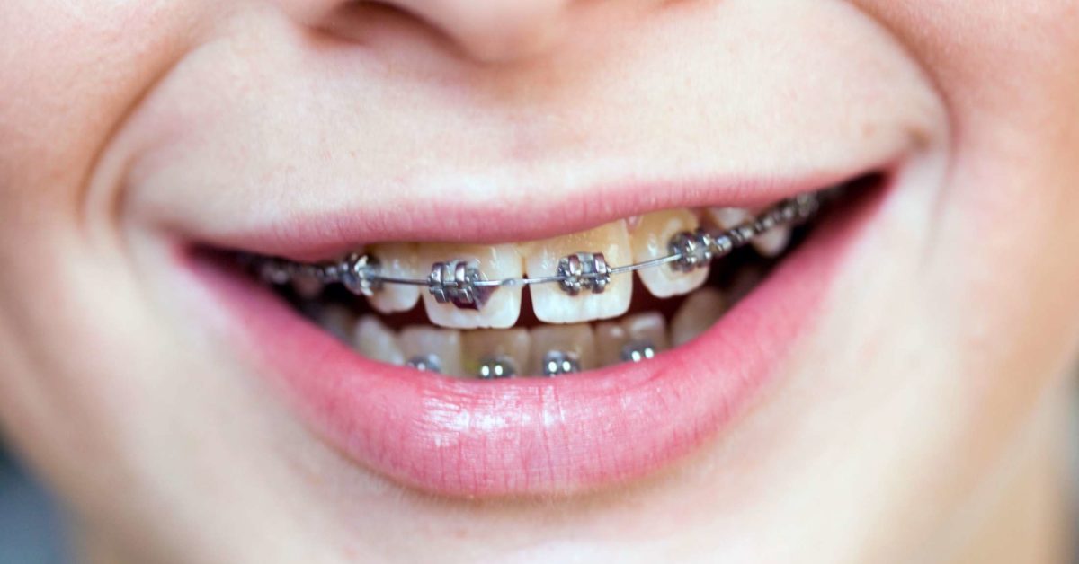 braces hurt dental teeth orthodontic extraction individual everything should know treatment getting crooked expect overbite correct wonder soon