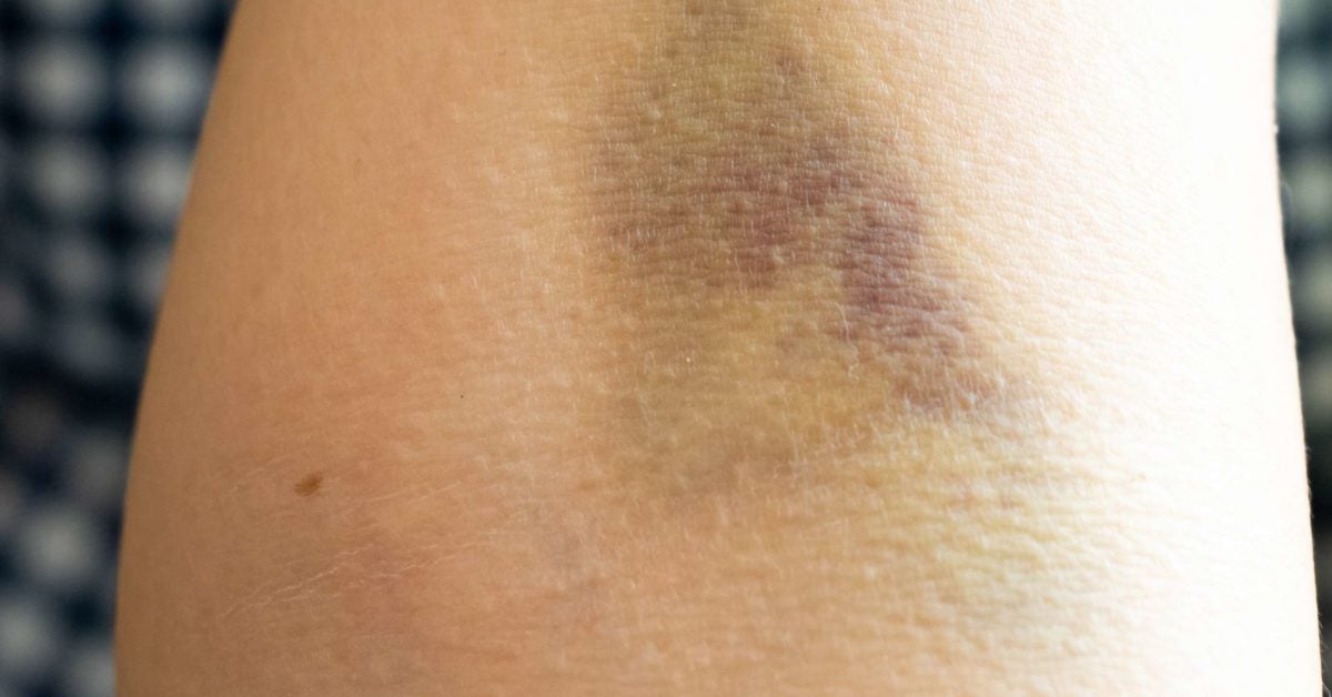 Bruising after a blood draw What does it mean?