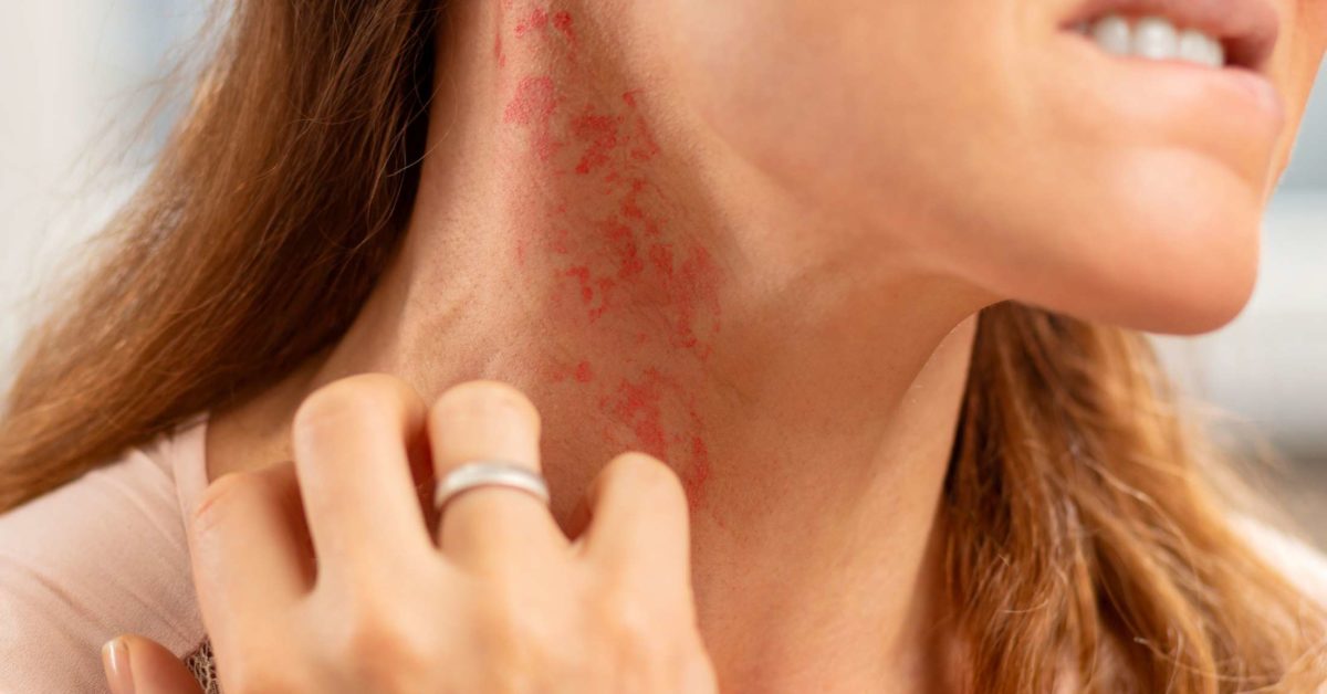 allergic skin rashes that itch