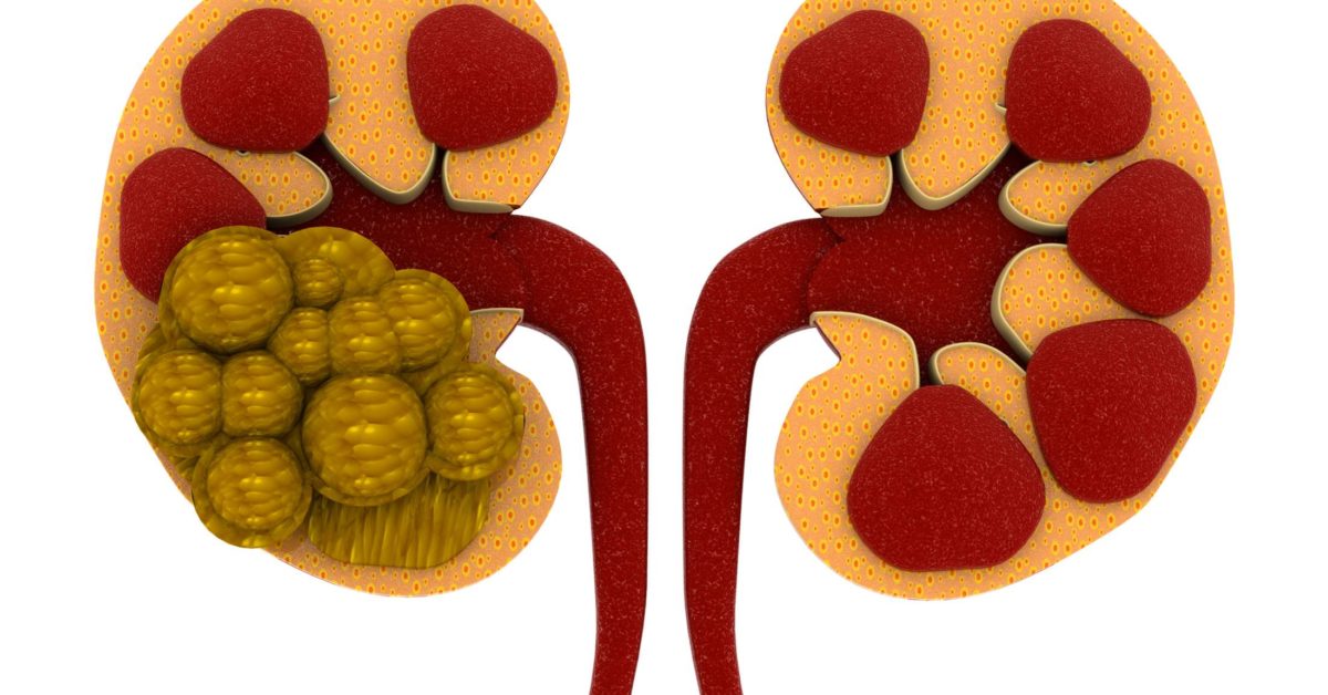 Kidney stones: Causes, symptoms, and treatment