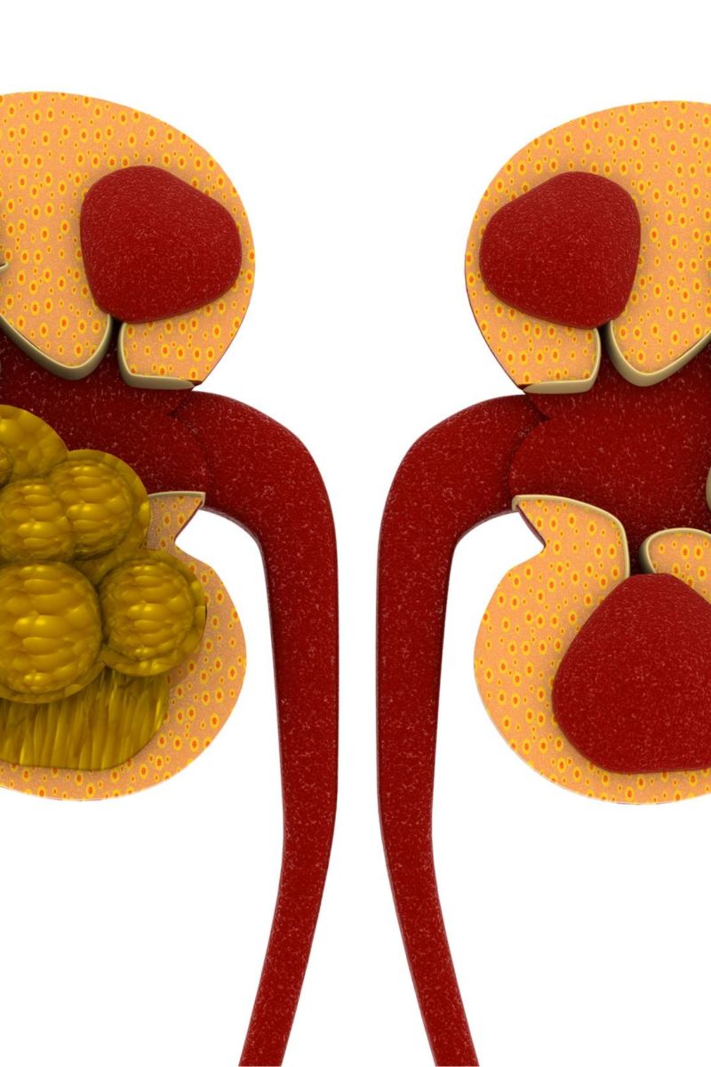 Kidney stones: Causes, symptoms, and treatment