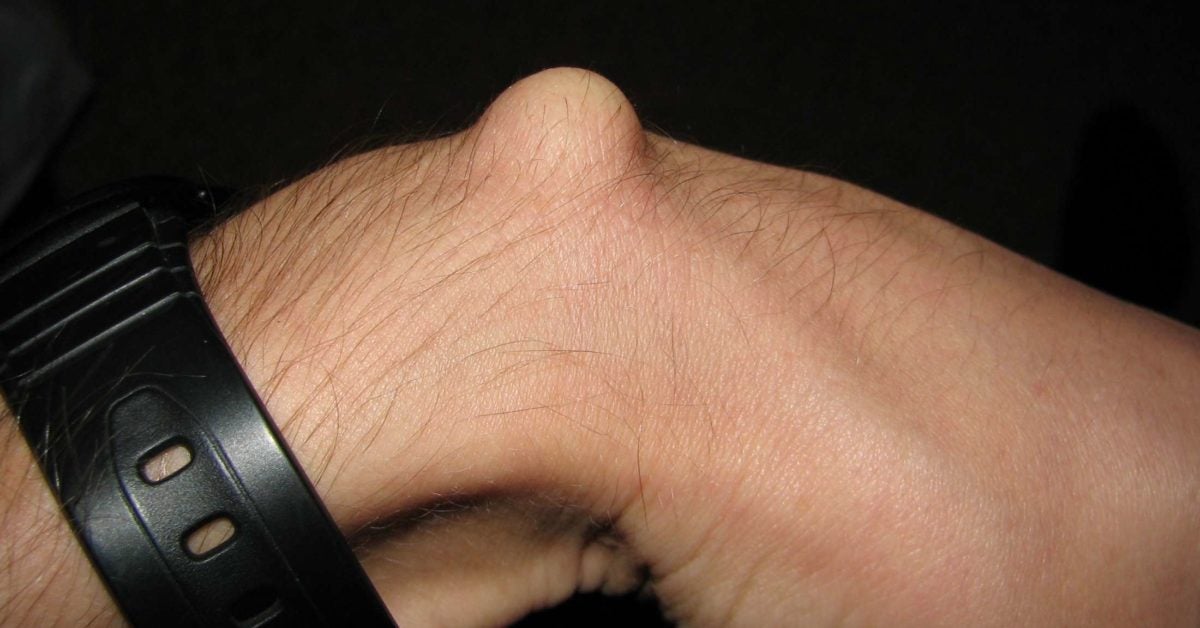 Ganglion Cyst Symptoms Causes And Treatment