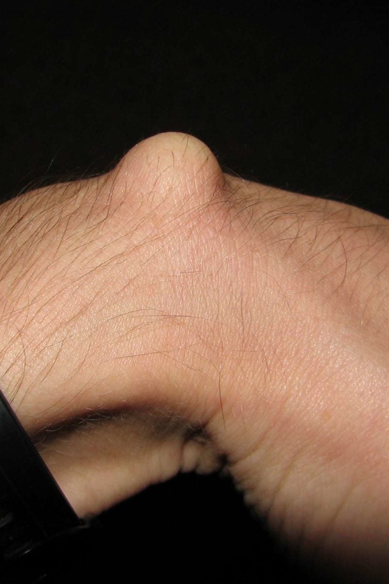 ganglion-cyst-symptoms-causes-diagnosis-and-treatment-rainy-weathers