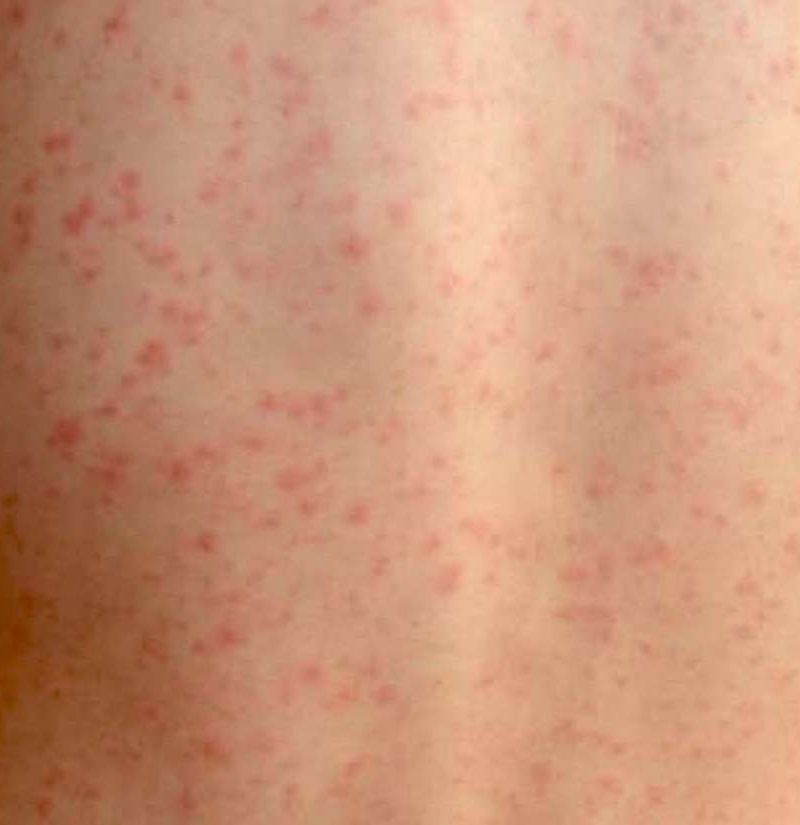 Can Scarlet Fever Rash Look Like Chicken Pox