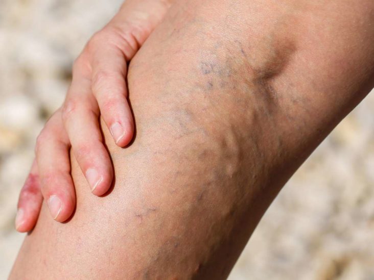 Rash On Inner Thigh 11 Causes Symptoms And Treatments