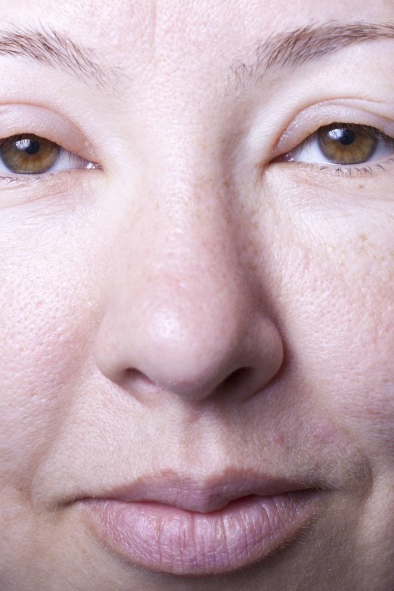 angioedema while pregnant