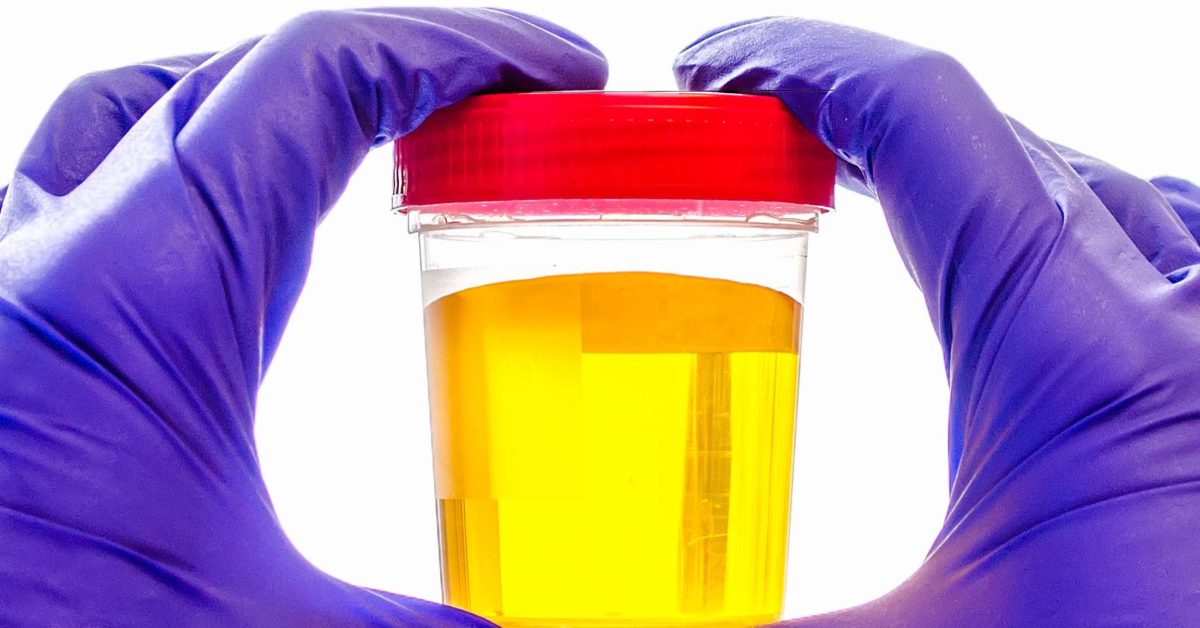 Why Is My Urine Deep Yellow In Colour