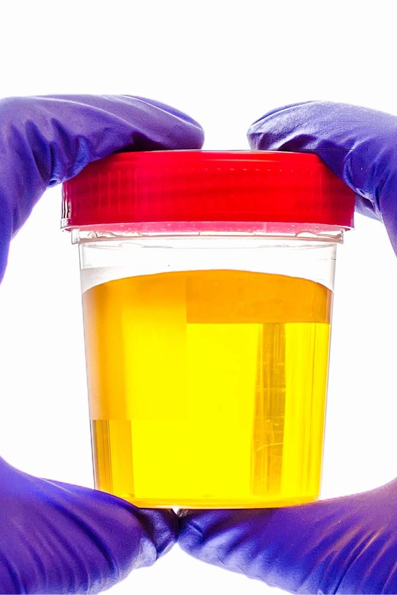 What Can Cause Bright Green Urine