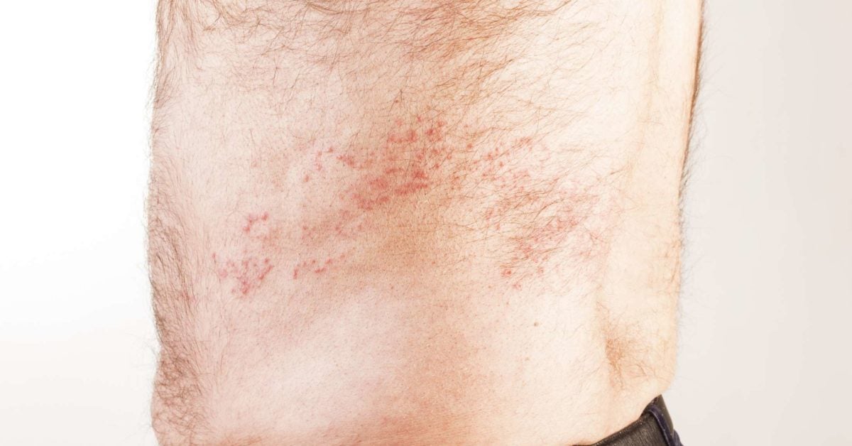 is-it-shingles-symptoms-vs-other-conditions-and-causes