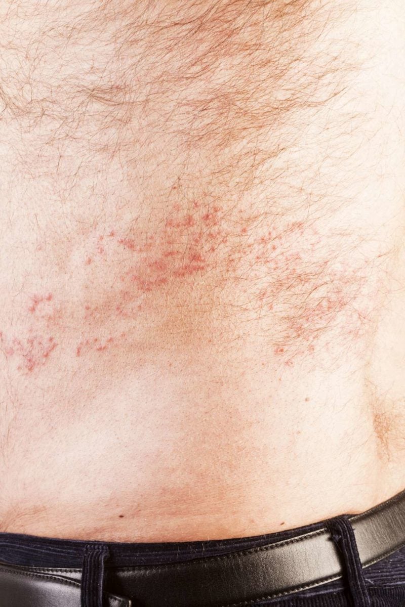 how long after treatment is shingles contagious