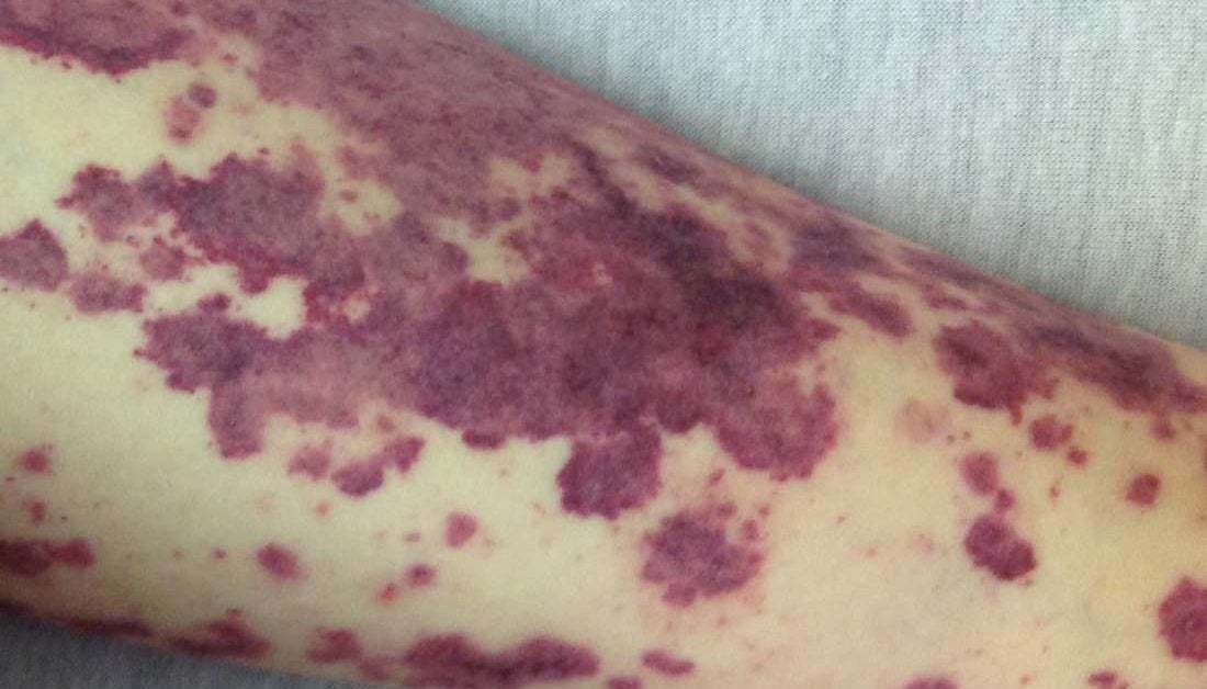Anemia rash: Symptoms, images, and treatment