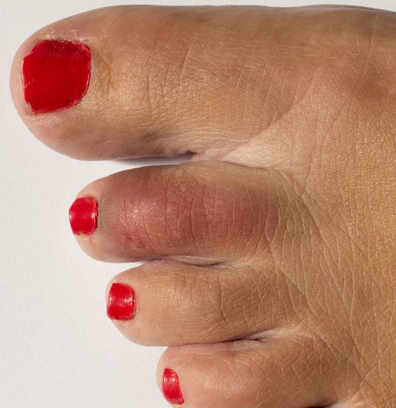 Broken Toe Symptoms Pictures And Treatment 