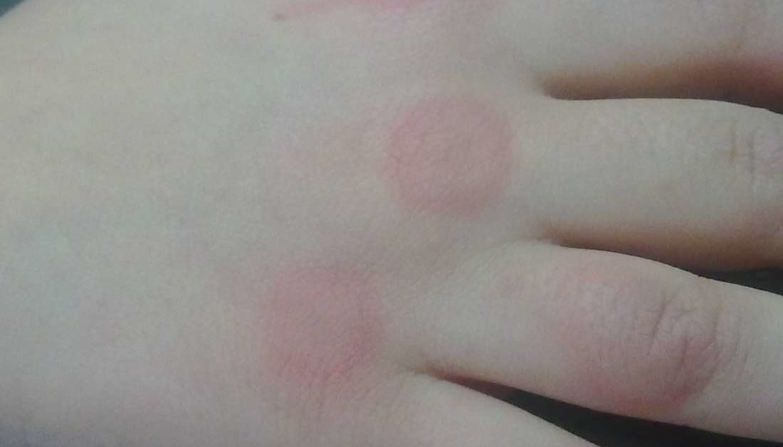 Carpet Beetle Bites Allergic Reaction Treatment Home Alqu