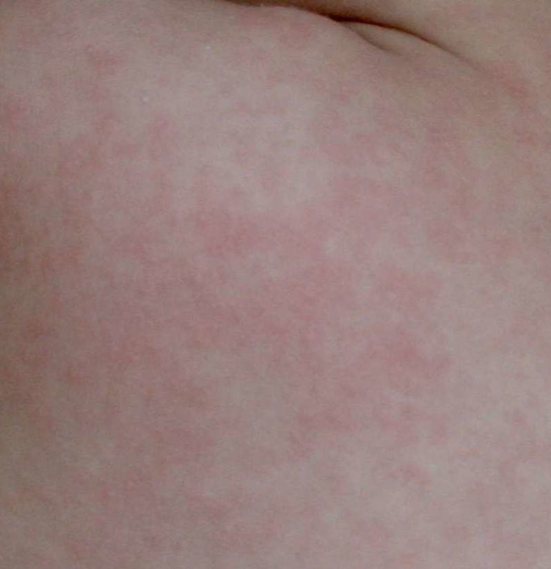 Roseola: Symptoms, causes, and treatment